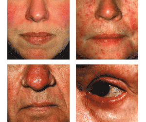Types of Rosacea: On Face