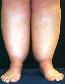 lipedema-fat-legs