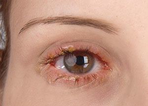 What Is Blepharitis: Symptoms, Causes and Treatments