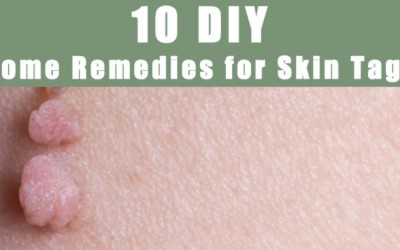 10 DIY Home Remedies For Skin Tag Removal