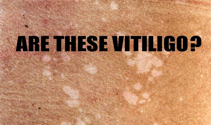 Are white patches on skin signs of vitiligo?