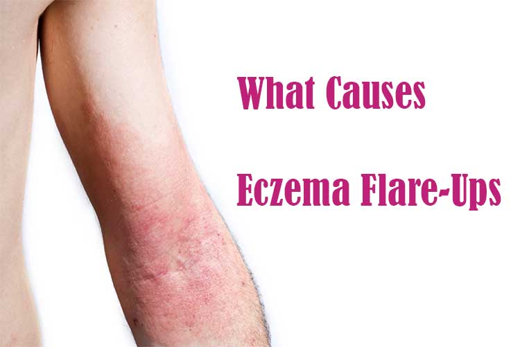 What Causes Eczema Flare-Ups