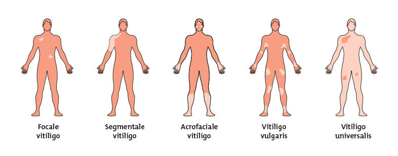 Types of Vitiligo