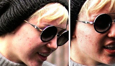 23 Celebrities Who Suffer Acne Breakouts and Skin Problems?