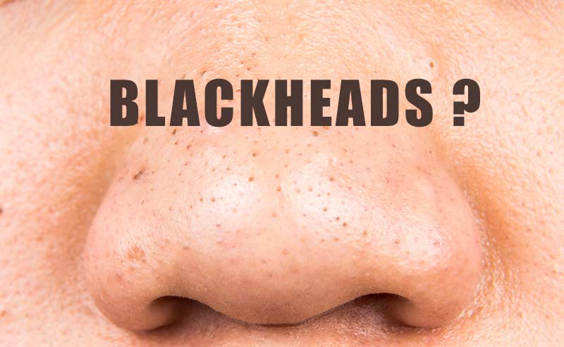 Black Heads & Clogged Pores