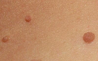What are Skin Tags and Other FAQs about Skin Tags
